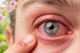 göz alerji