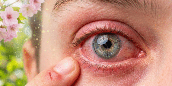 göz alerji
